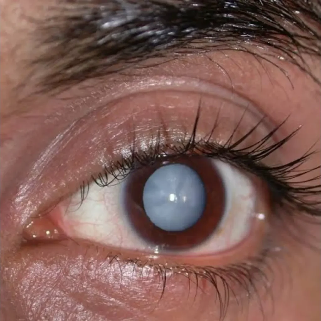 Best Eye Hospital in Mumbai for Cataract Surgery - dholakia eye care