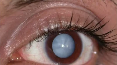 Best Eye Hospital in Mumbai for Cataract Surgery - dholakia eye care