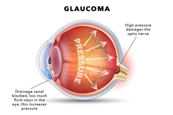 GLAUCOMA